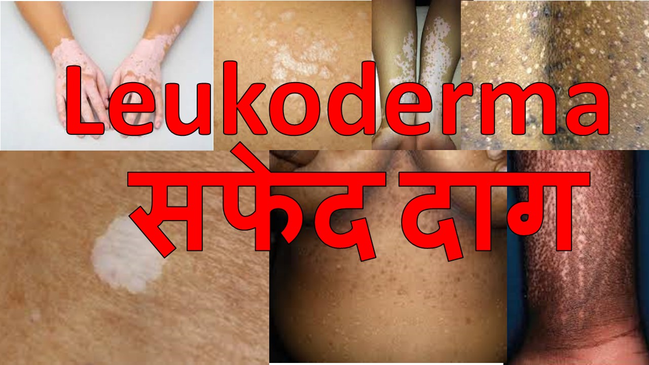  how to cure leukoderma